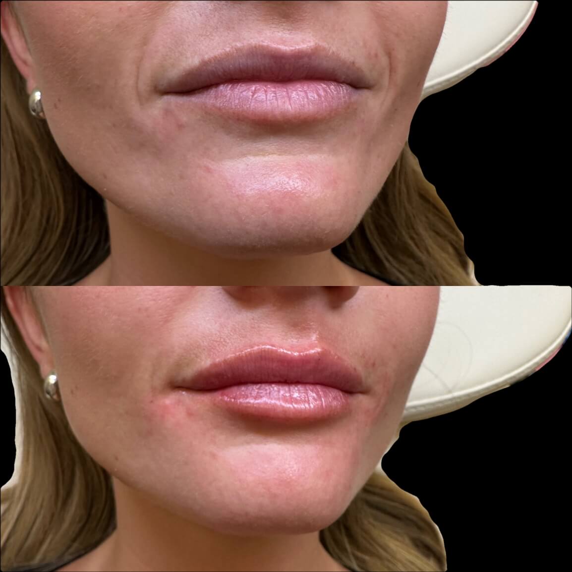lip hydration treatment before and after photos