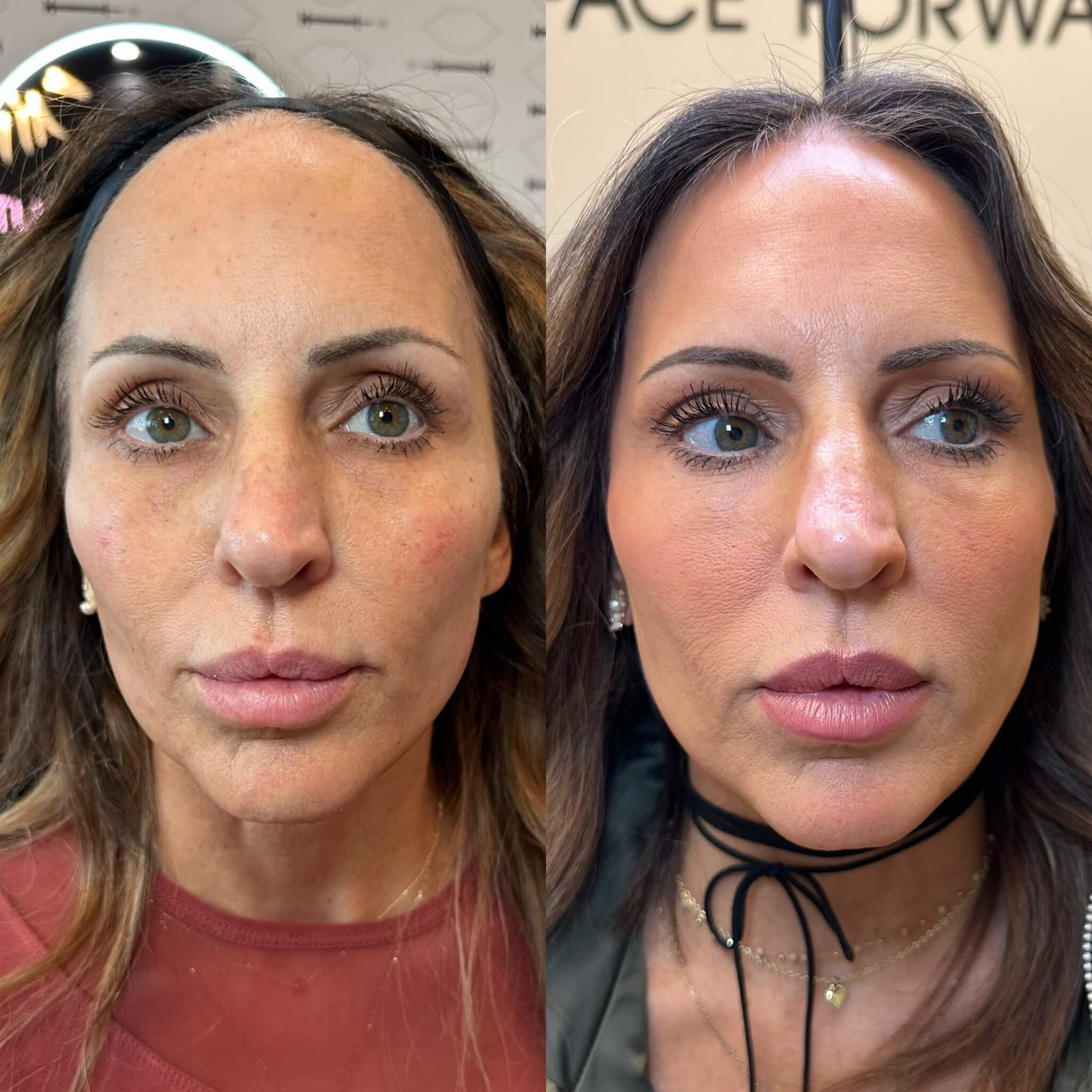  aesthetic treatments before and after photo