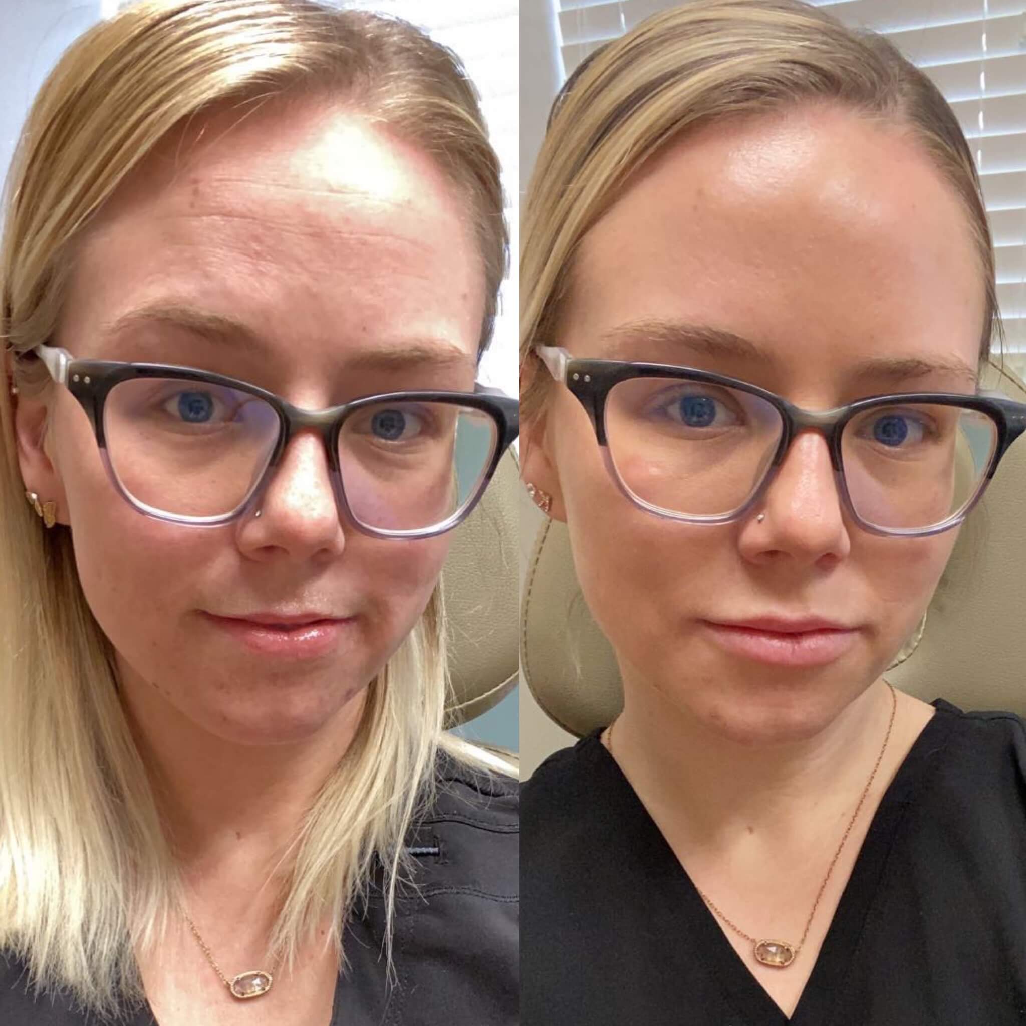 botox treatment before and after photos 