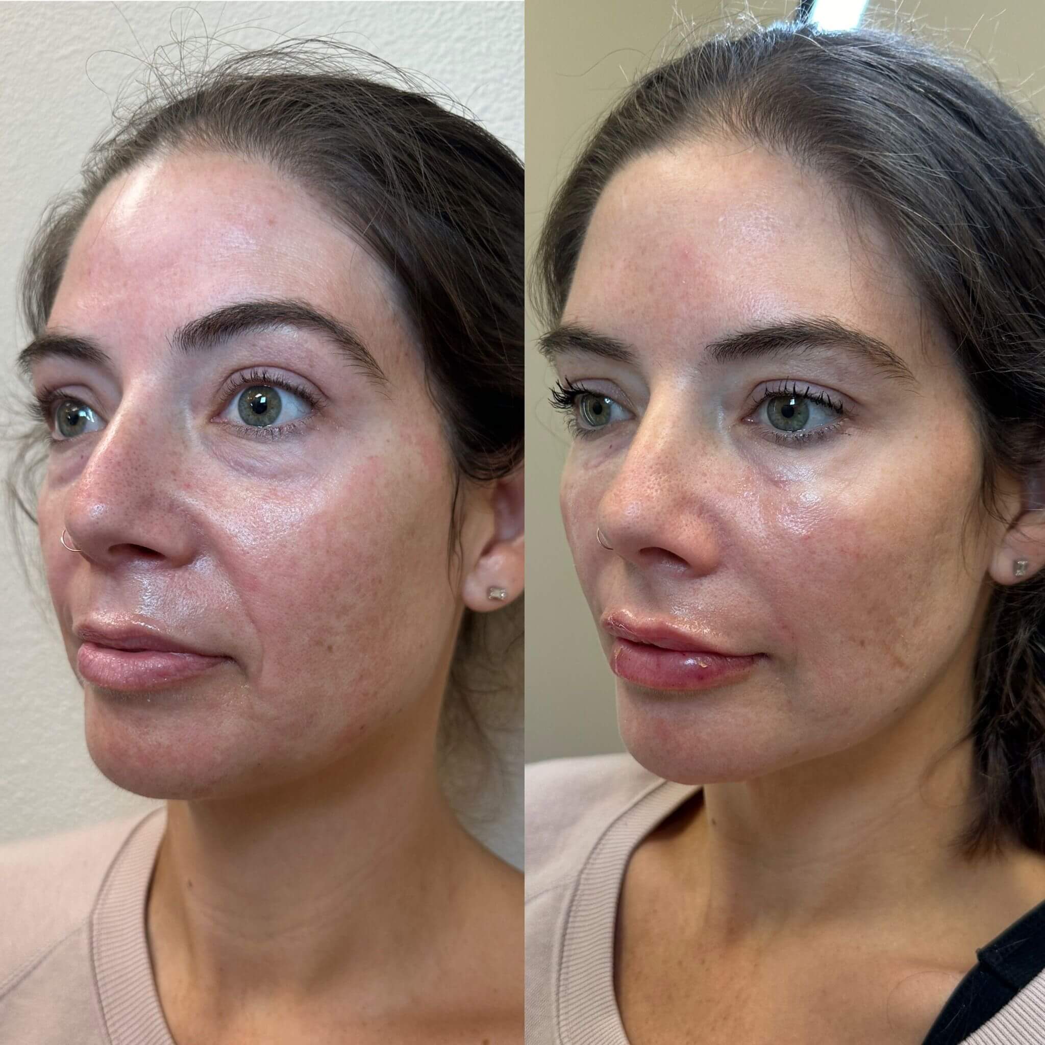  filler before and after photos