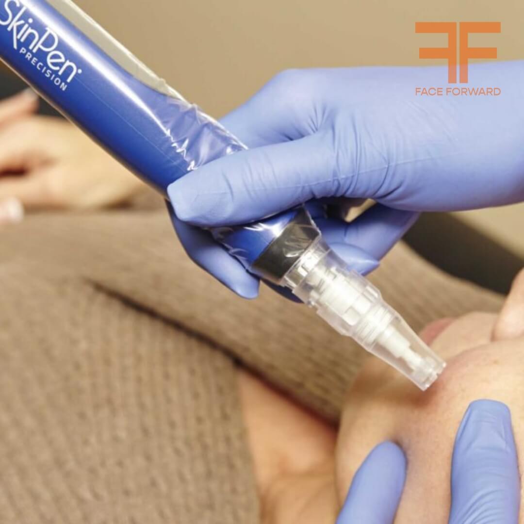 Microneedling - SkinPen®