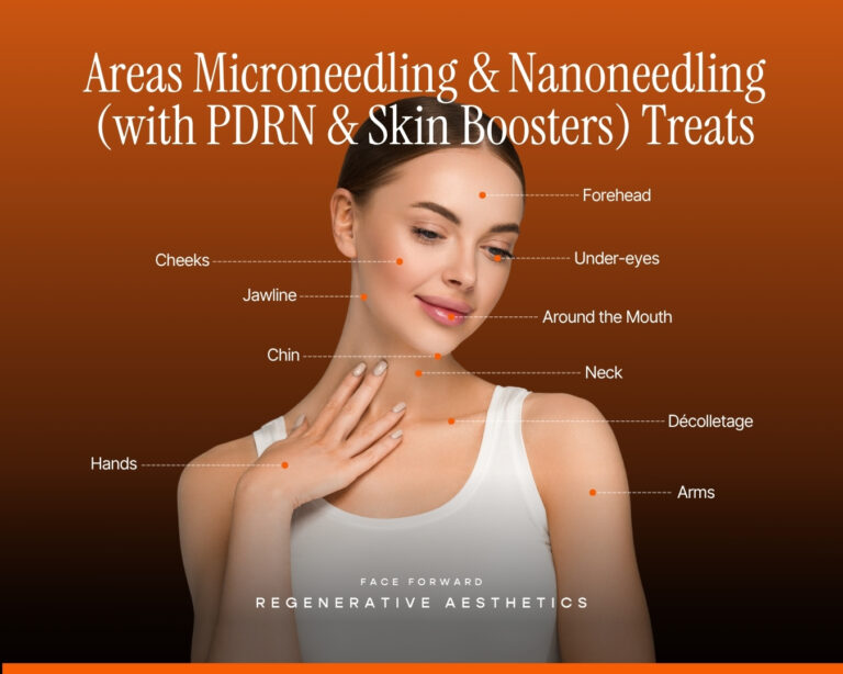 Diagram showing areas for microchanneling and nanoneedling with PDRN skin boosters at Face Forward in St. Louis, MO, highlighting targeted skin rejuvenation and collagen induction therapy