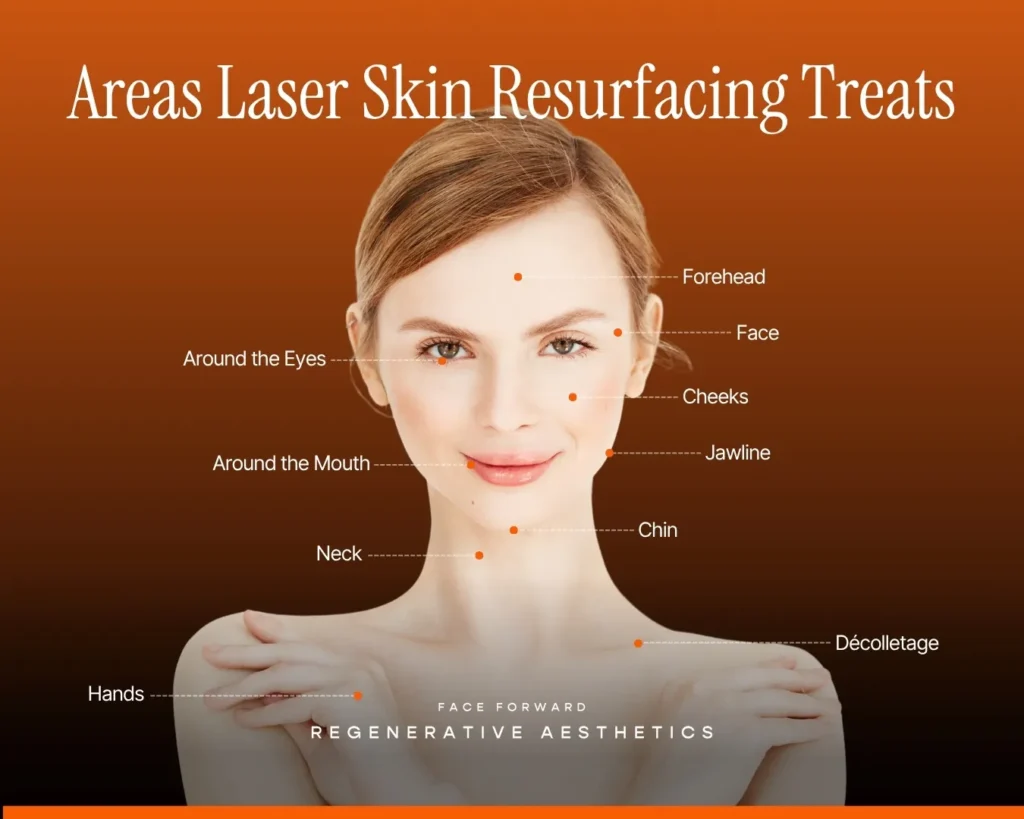 Graphic of woman with areas labeled that Laser Skin Resurfacing treats