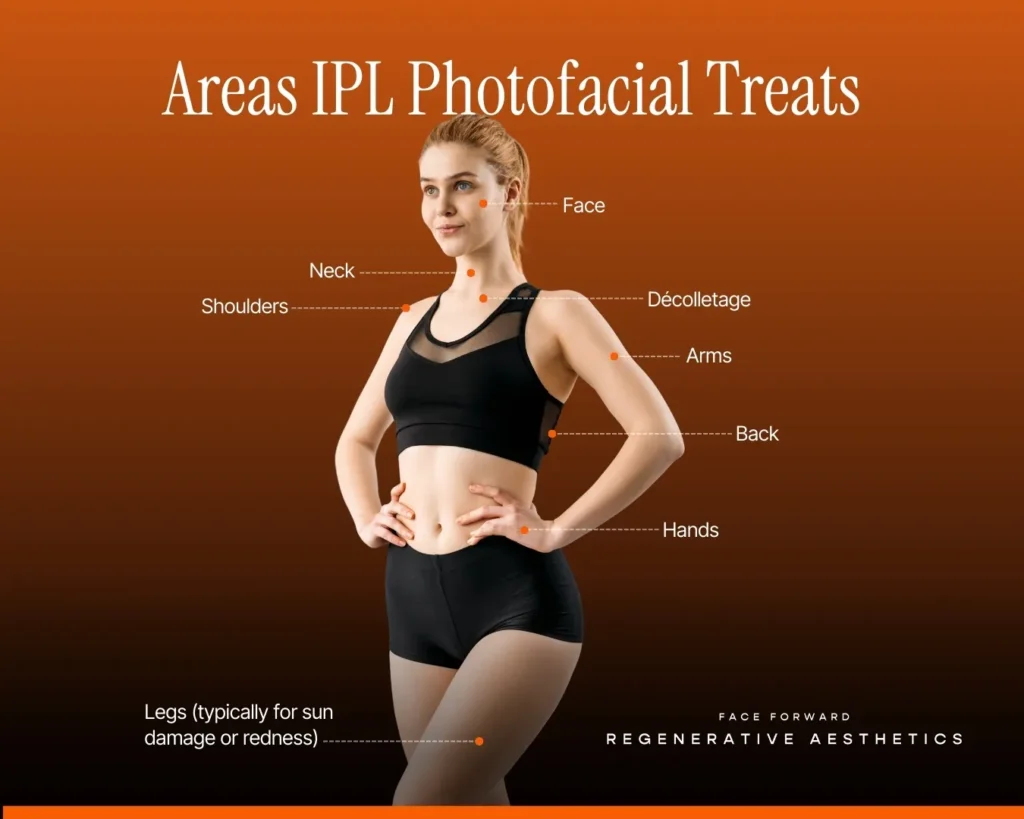 Areas IPL treats