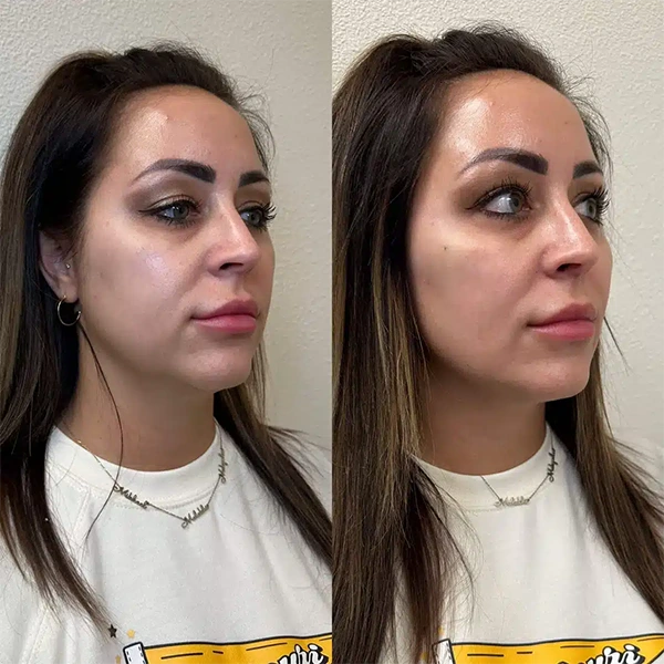 face-forward-aesthetic-clinic-st-louis-missouri-10