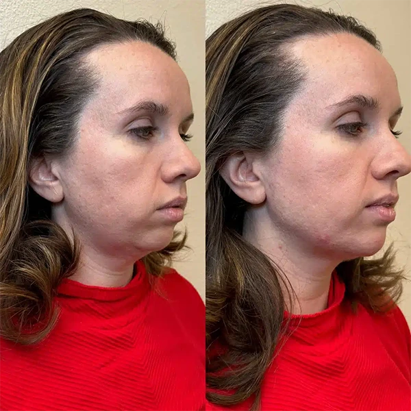 face-forward-aesthetic-clinic-st-louis-missouri-11